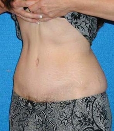 Tummy Tuck