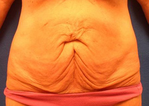 Tummy Tuck