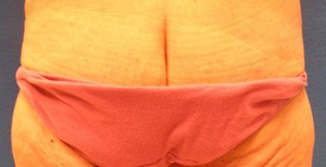 Tummy Tuck