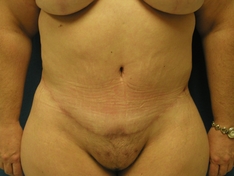 Tummy Tuck