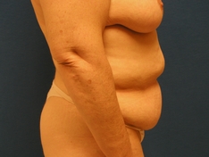 Tummy Tuck