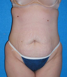 Tummy Tuck