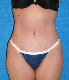 Tummy Tuck