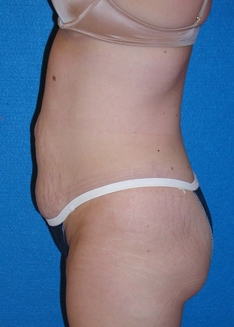 Tummy Tuck