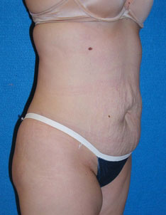 Tummy Tuck