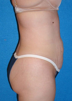 Tummy Tuck