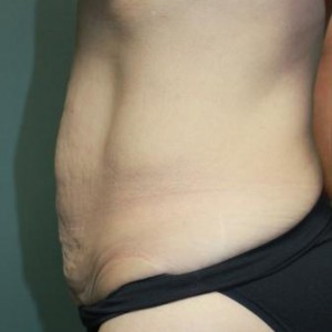 Tummy Tuck