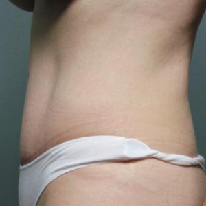 Tummy Tuck