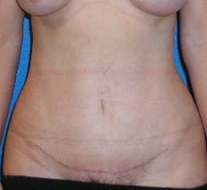 Tummy Tuck