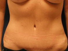 Tummy Tuck