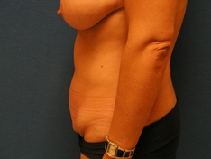 Tummy Tuck