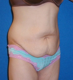 Tummy Tuck