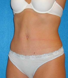 Tummy Tuck