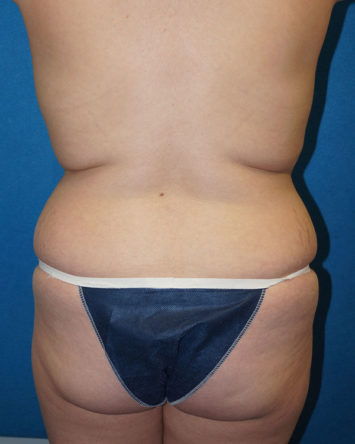 Tummy Tuck