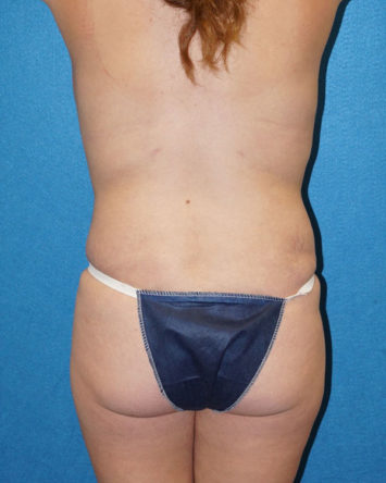 Tummy Tuck