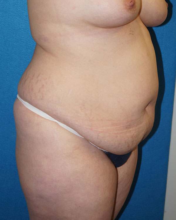 Tummy Tuck