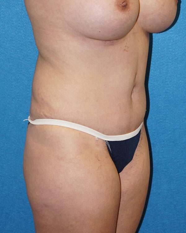 Tummy Tuck