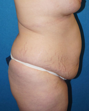 Tummy Tuck