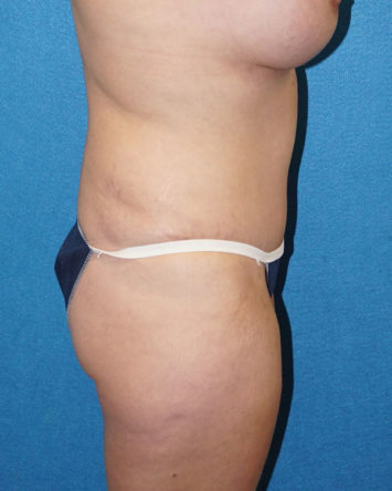 Tummy Tuck