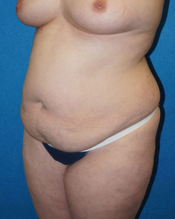 Tummy Tuck