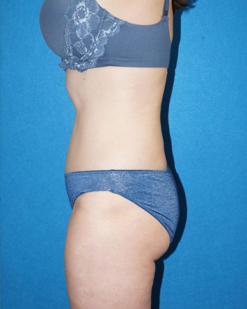 Tummy Tuck