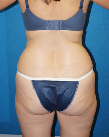 Tummy Tuck