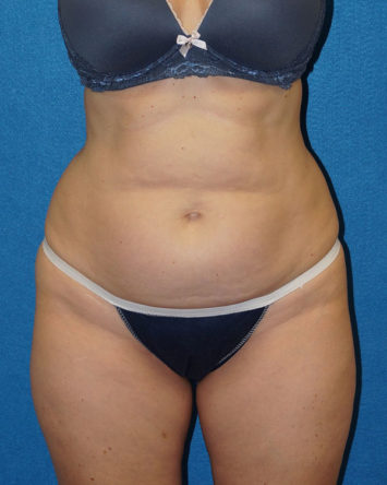 Tummy Tuck