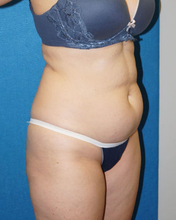 Tummy Tuck