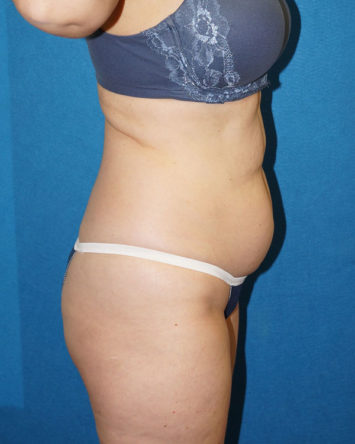 Tummy Tuck