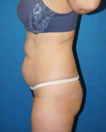 Tummy Tuck