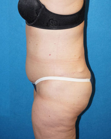 Tummy Tuck