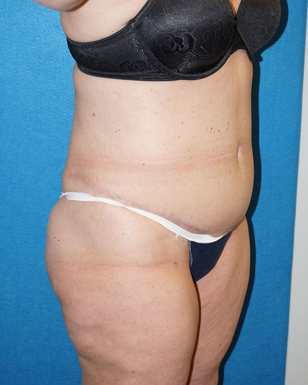 Tummy Tuck