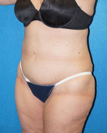 Tummy Tuck