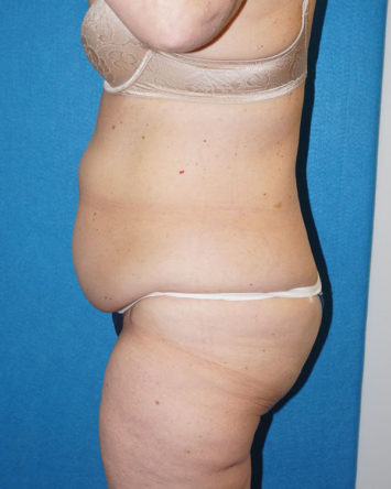 Tummy Tuck