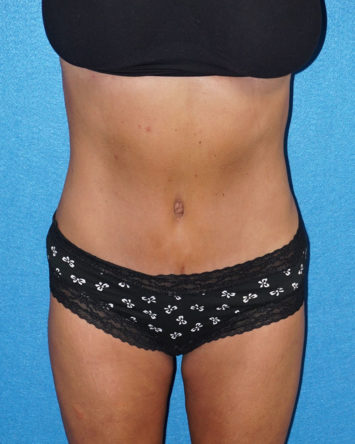 Tummy Tuck