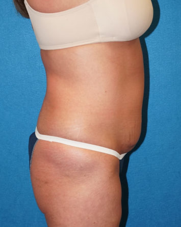 Tummy Tuck