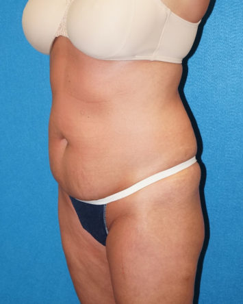 Tummy Tuck