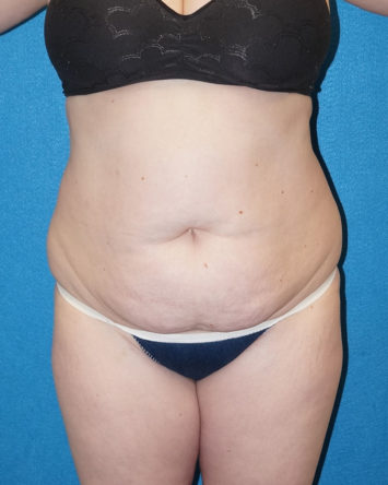 Tummy Tuck