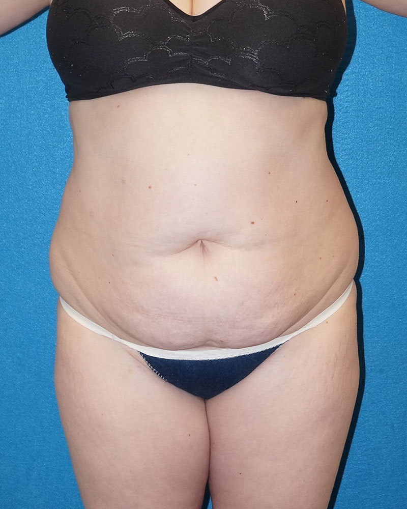 Tummy Tuck