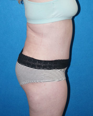 Tummy Tuck