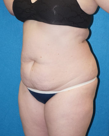 Tummy Tuck