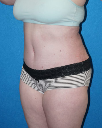 Tummy Tuck