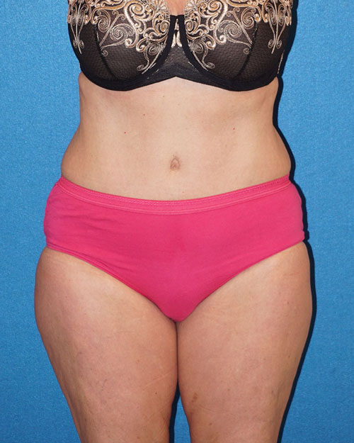 Tummy Tuck