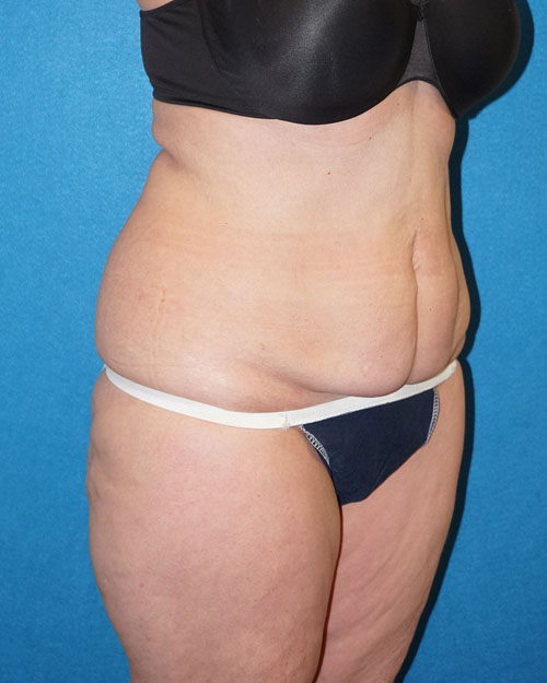 Tummy Tuck