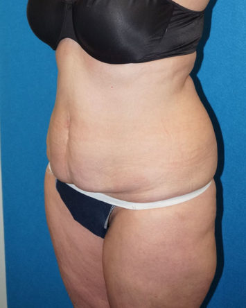 Tummy Tuck