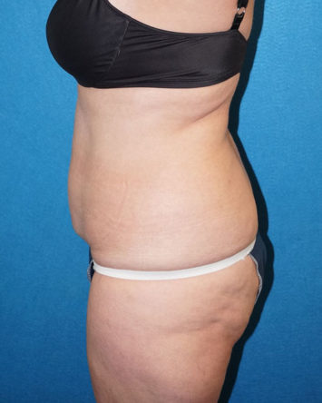 Tummy Tuck