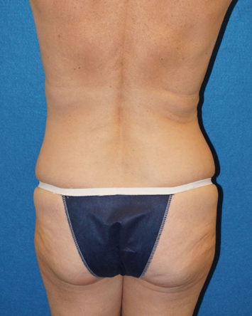 Tummy Tuck