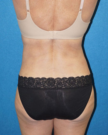 Tummy Tuck