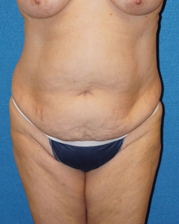 Tummy Tuck