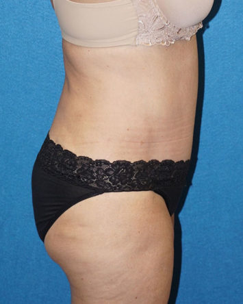 Tummy Tuck